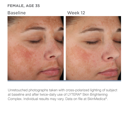 SkinMedica Lytera Before and After