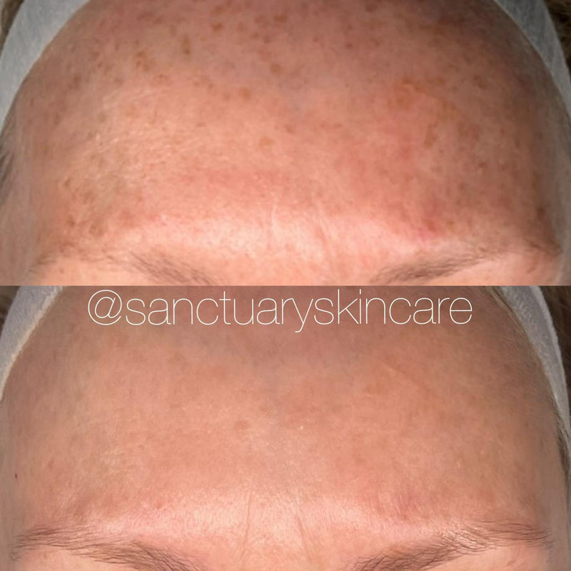 2 Treatments