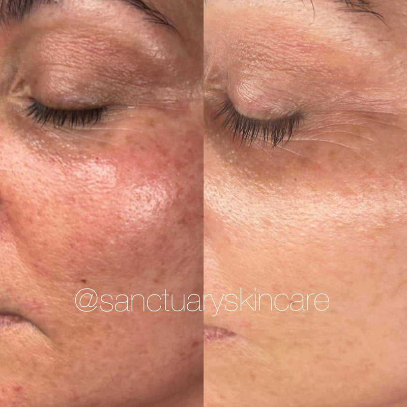 2 Treatments