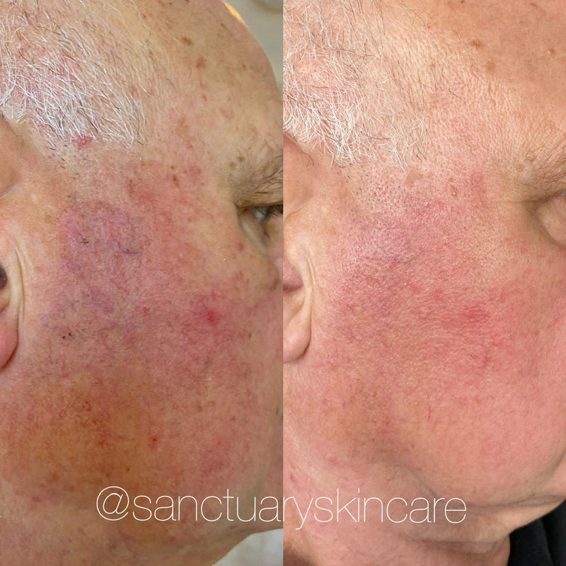 2 Treatments