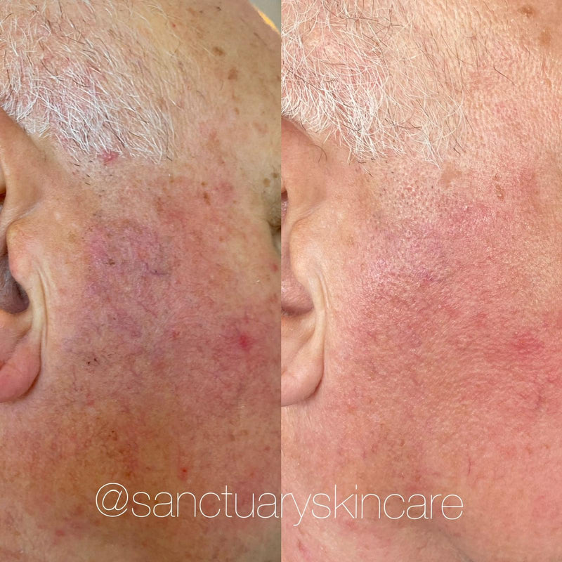 2 Treatments
