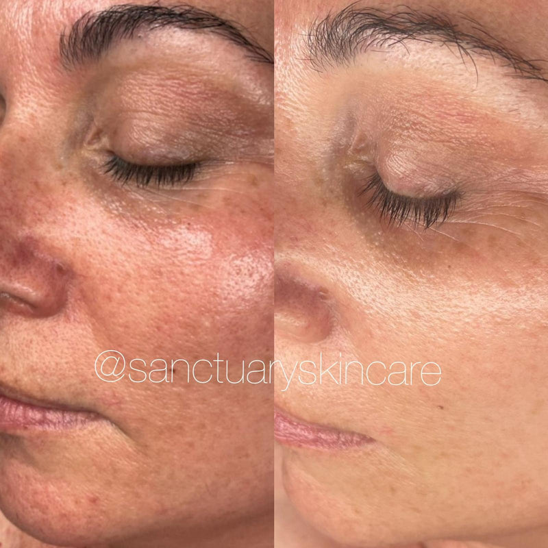 2 Treatments