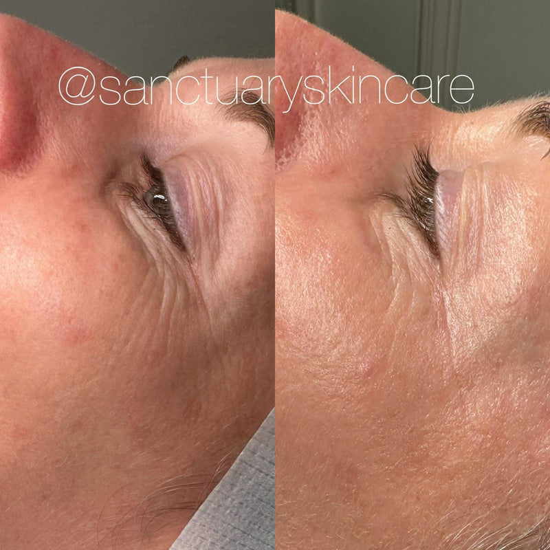 1 Treatment
