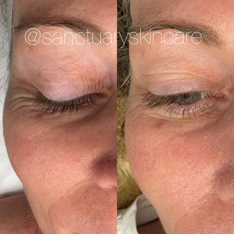 1 Treatment