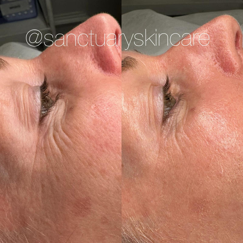 1 Treatment
