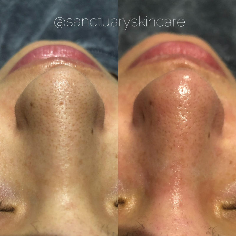 1 Treatment