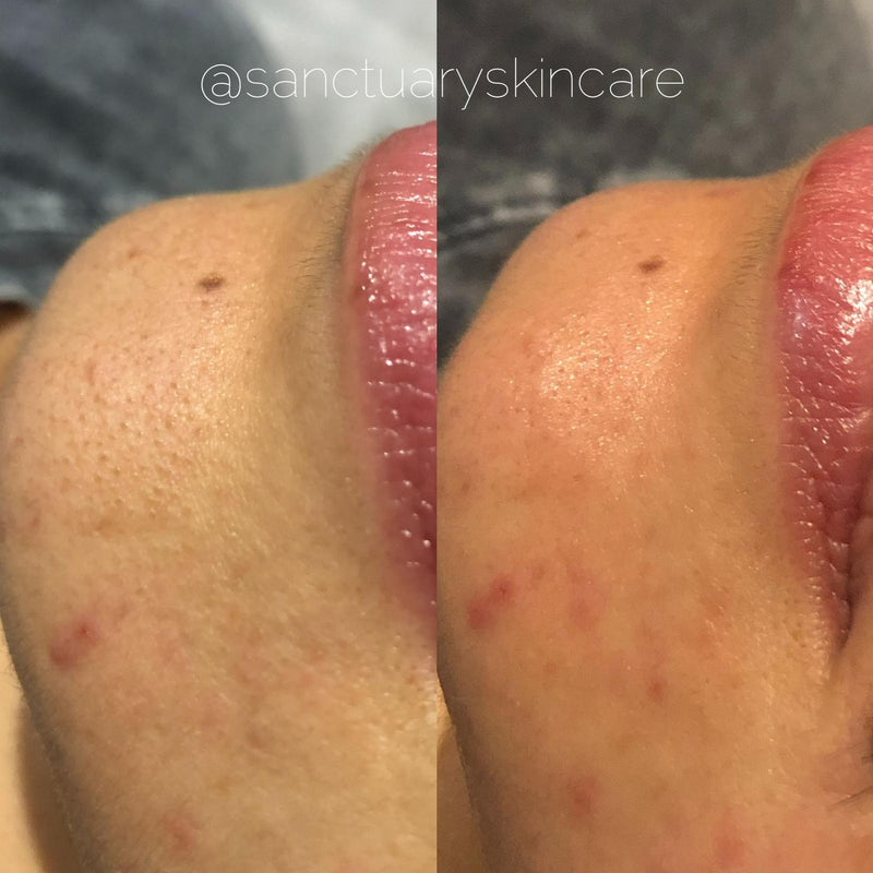 1 Treatment