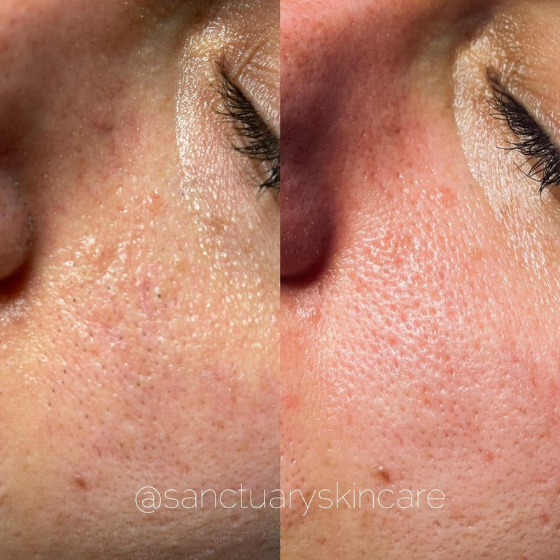 1 Treatment
