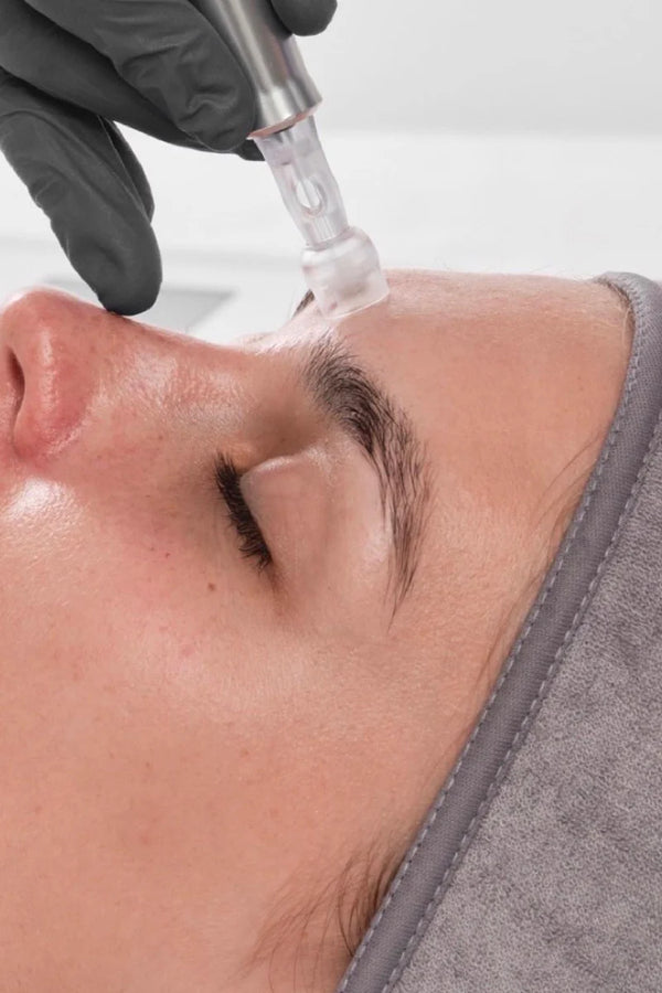 Close-up of a skincare procedure being performed on a person's face with a gloved hand holding an applicator.