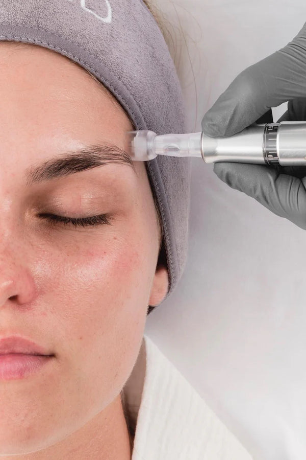 Skin Needling at Sanctuary Skin Care