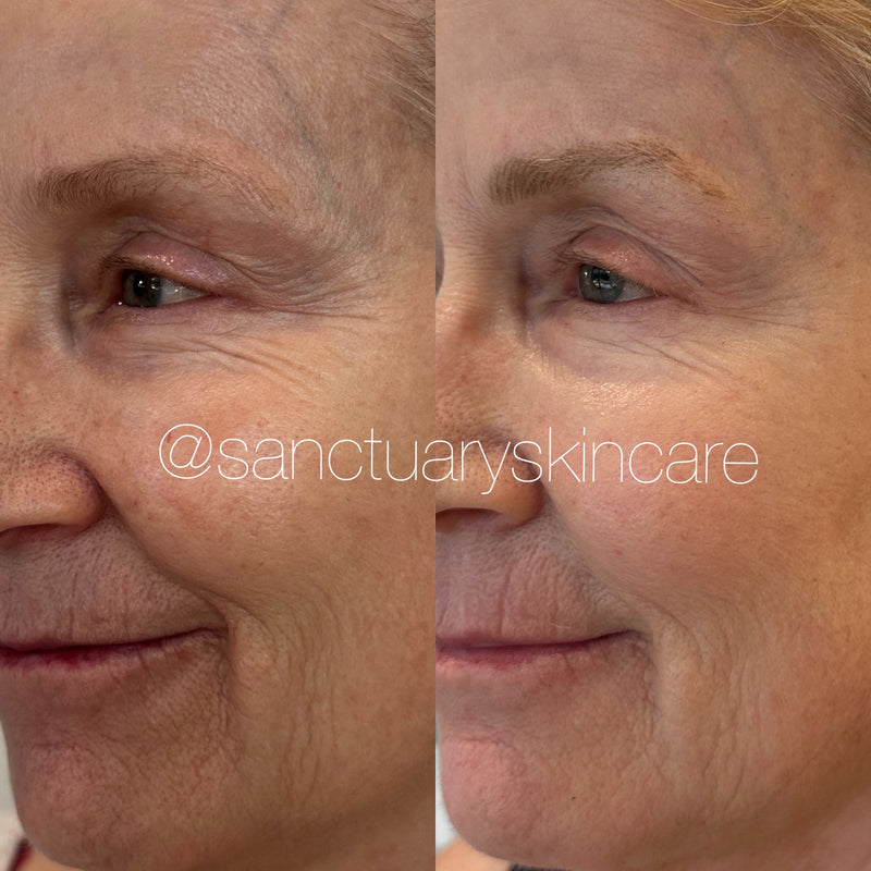 2 Treatments