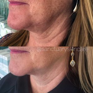 Sydney HIFU Treatment Client Before and After Results