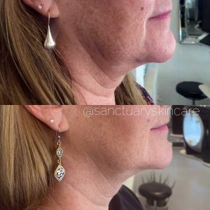 Sydney HIFU Treatment Client Before and After Results