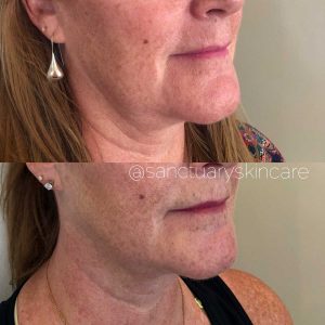 Sydney HIFU Treatment Client Before and After Results