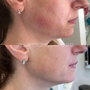 Sydney HIFU Treatment Client Before and After Results