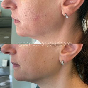 Sydney HIFU Treatment Client Before and After Results