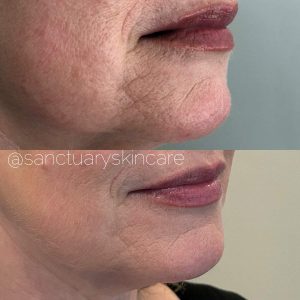 Sydney HIFU Treatment Client Before and After Results