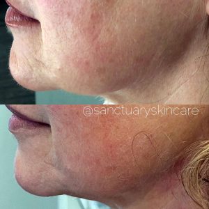 Sydney HIFU Treatment Client Before and After Results