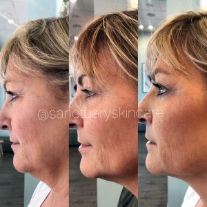 Sydney HIFU Treatment Client Before and After Results