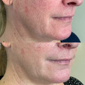 Sydney HIFU Treatment Client Before and After Results