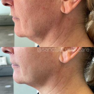 Sydney HIFU Treatment Client Before and After Results