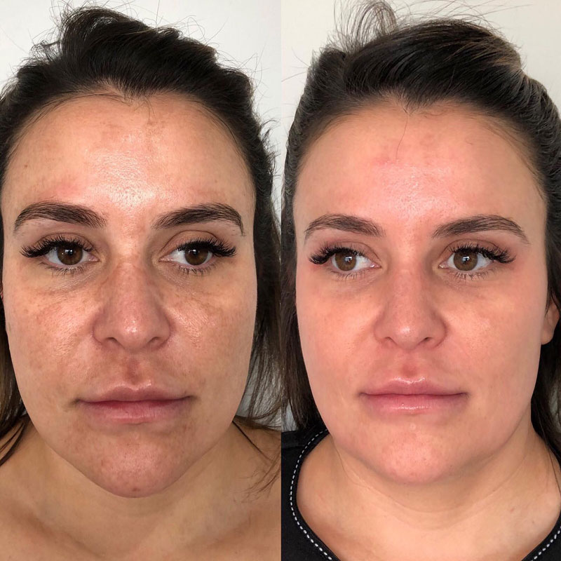 Cosmelan Before and After Results