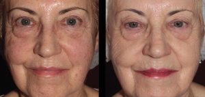 BBL Corrective Pigmentation Before and After Results