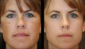 BBL Corrective Pigmentation Before and After Results