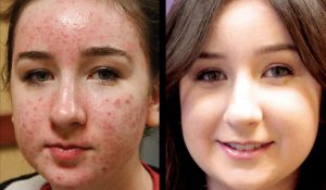 BBL Corrective Pigmentation Before and After Results