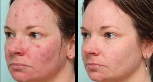 Before and After Results