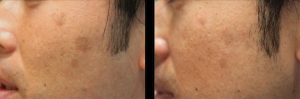 BBL Corrective Pigmentation Before and After Results