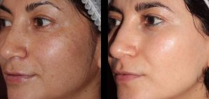 BBL Corrective Pigmentation Before and After Results