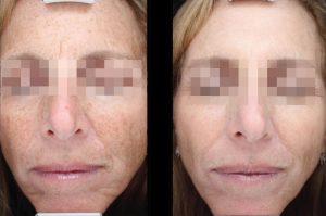 BBL Corrective Vascular Before and After Results