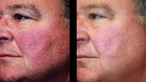 BBL Forever Young Before and After Results
