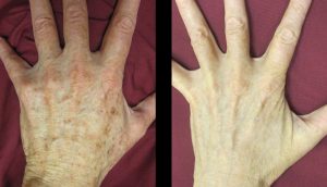 BBL Forever Young Before and After Results
