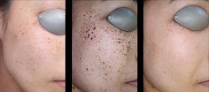 BBL Corrective Rosacea Before and After Results
