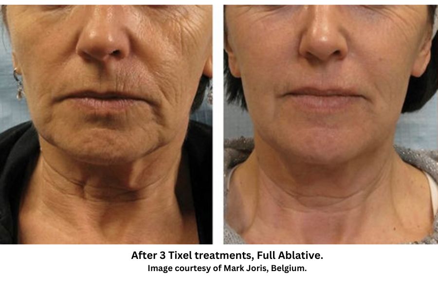 Before and after results - After 3 treatments, Full Ablative. Image courtesy of Mark Joris, Belgium.