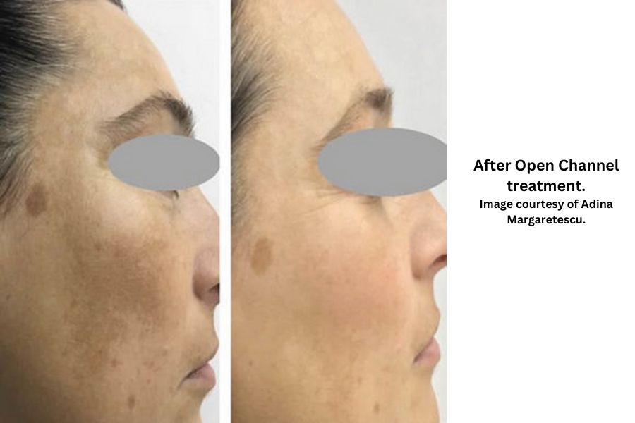 After Open Channel treatment. Image courtesy of Adina Margaretescu. 